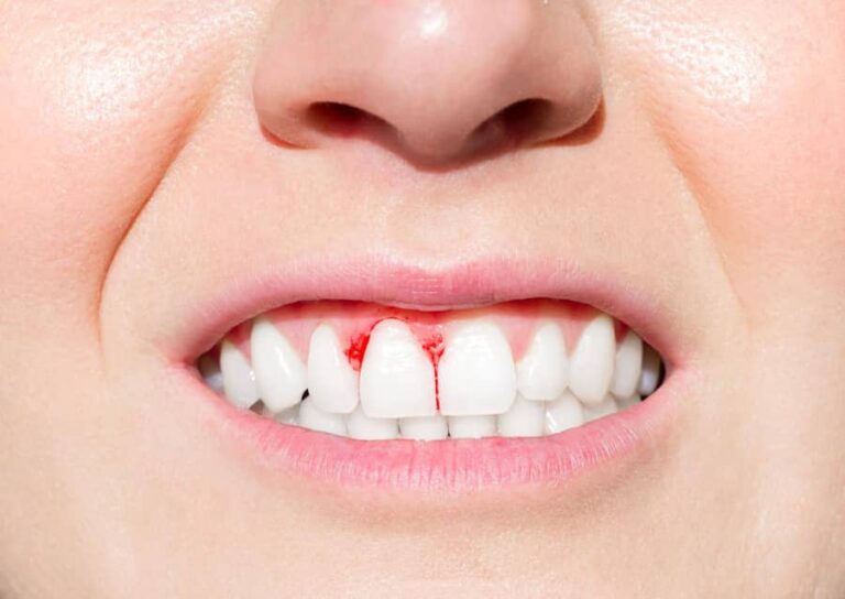 Un gros plan des dents d'une femme avec du sang dessus.